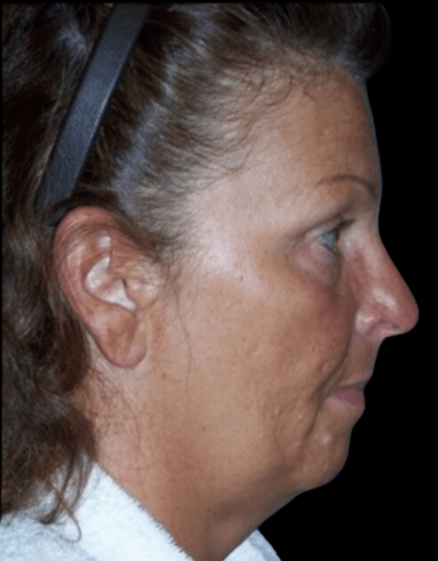 SMART Facelift Before & After