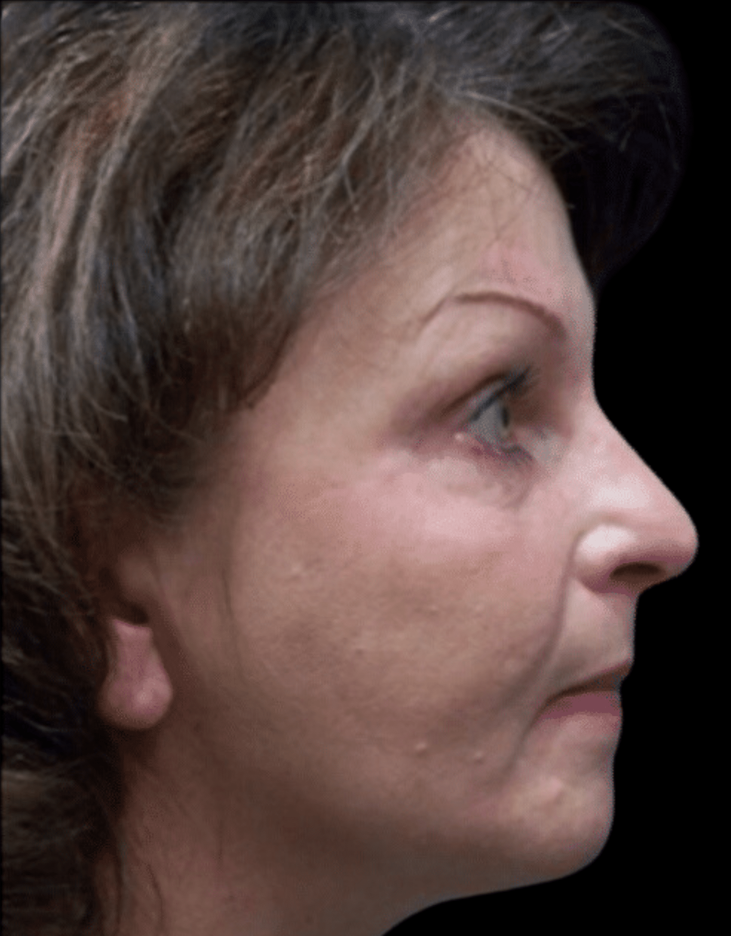 SMART Facelift Before & After